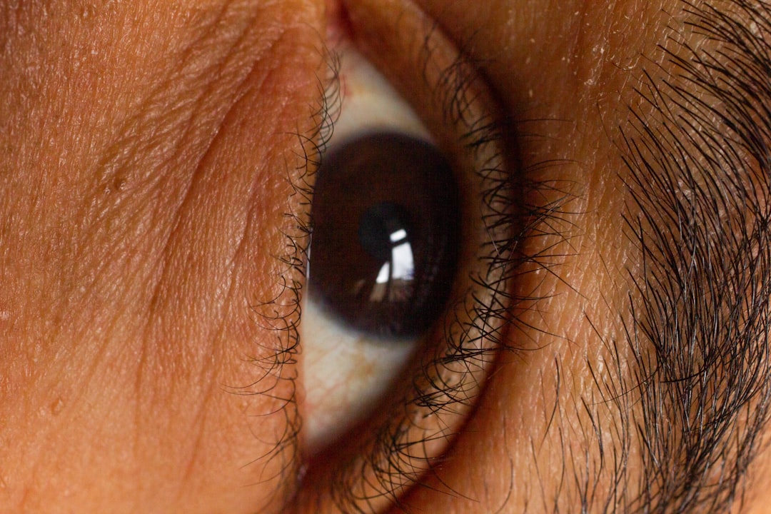 Cataract
