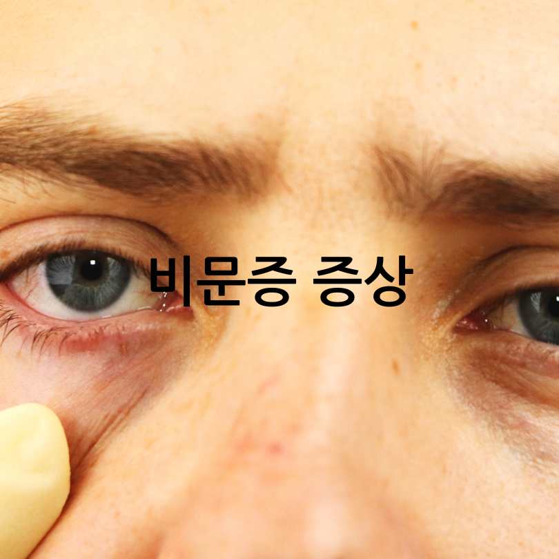 비문증(날파리증)