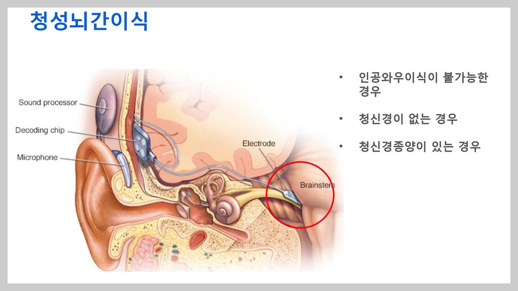 청성뇌간이식