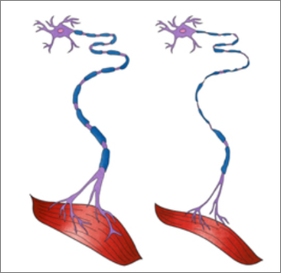 근위축성 측색 경화증