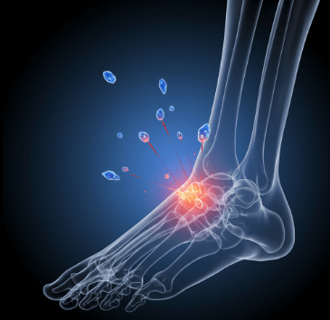 발목 통풍 응급 대처법1