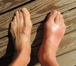 족저근막염 병원