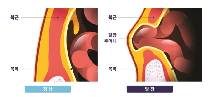 탈장