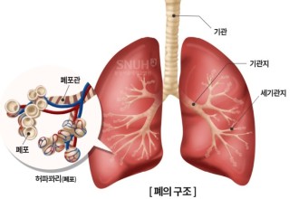 호흡기 질환: 폐렴- 증상, 원인, 전염성, 예방접종, 예방법.