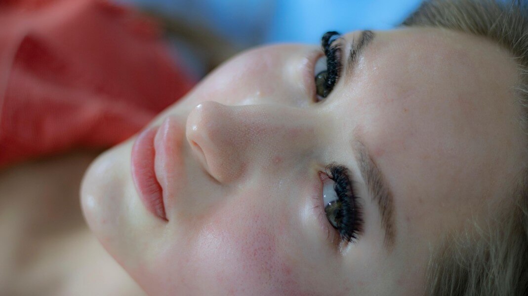 화농성 여드름을 가진 여성