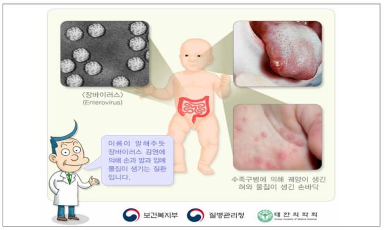 수족구병이란