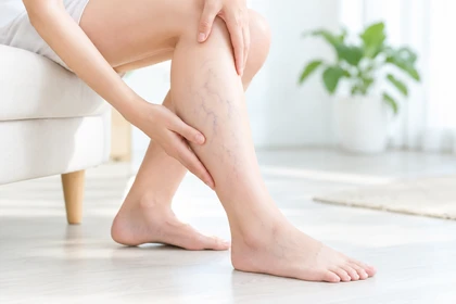 하지정맥류증상으로 나타나는 다리 변화6