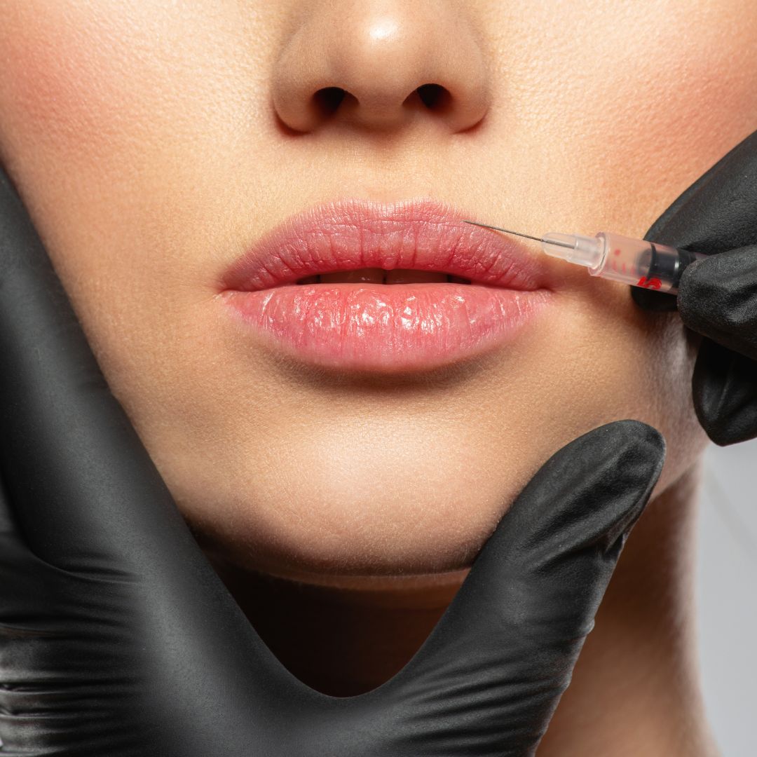 입꼬리 필러 관련 사진