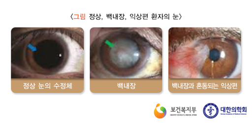 백내장 증상과 안과 병원 추천