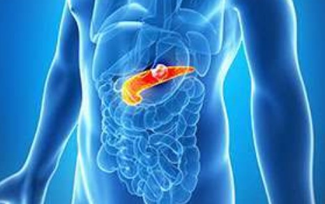 췌장암 초기증상과 췌장손상 위험 신호