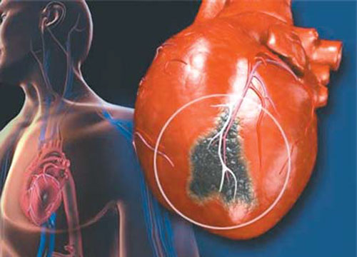 심근경색 전조증상