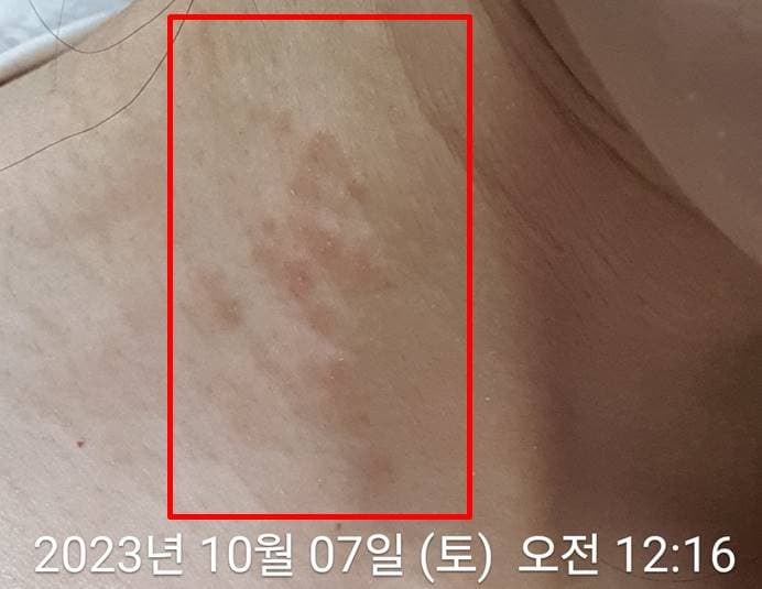 목 피부염