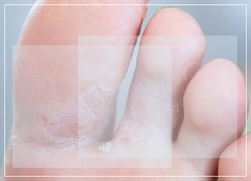 만성 각화형 무좀