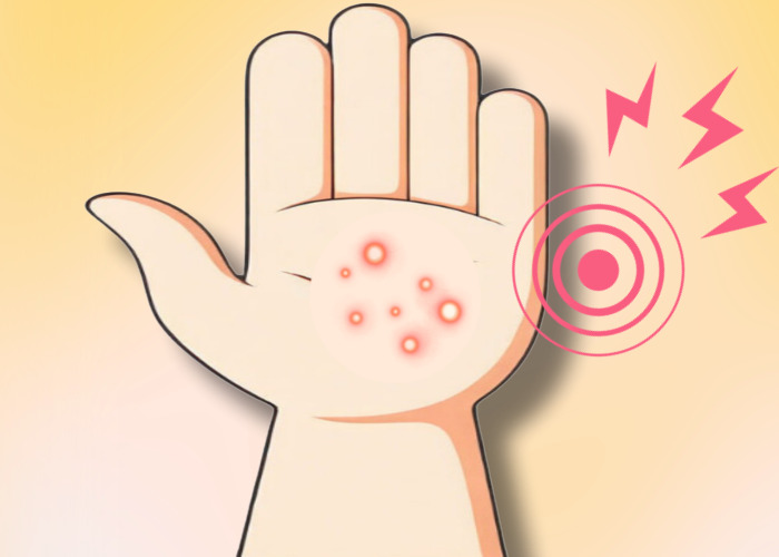 손바닥에-대상포진이-발생한모습