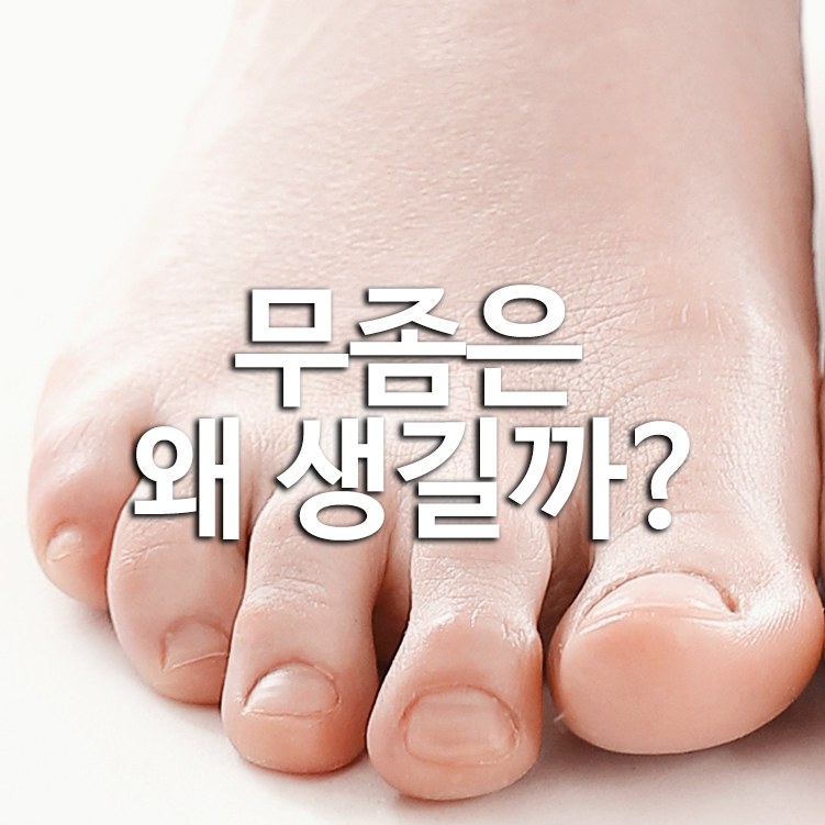 무좀은 왜 생길까?
