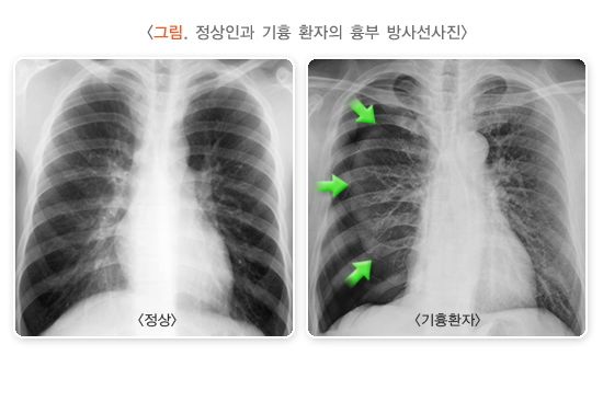 호흡기 질환: 기흉- 증상, 원인, 치료방법, 재발원인, 후유증.