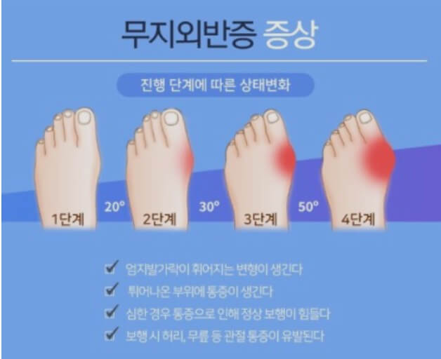 무지외반증 발가락 각도별 증상