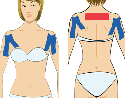 견관절 주위염으로 어깨결림의 테이핑요법