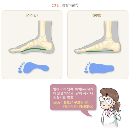 평발(1)