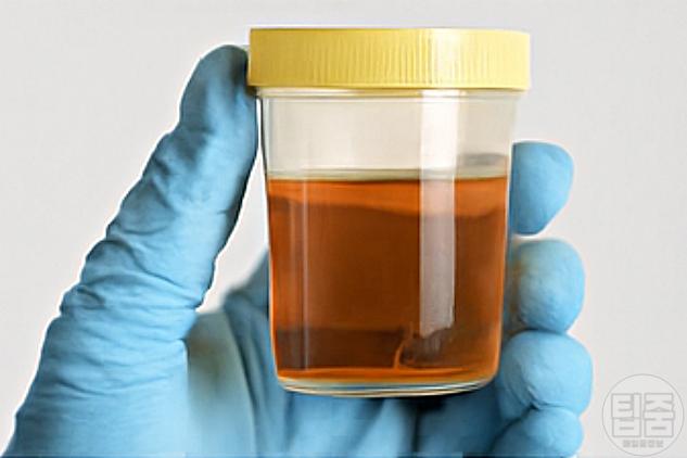 탈수증 물이 부족하면 생기는 현상 소변색깔