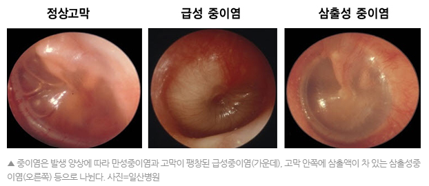 중이염 종류 별 사진 예시