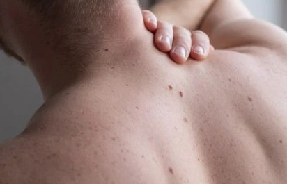 등여드름(등드름), 가슴여드름(가드름) 원인, 치료방법, 흉터 없애는법