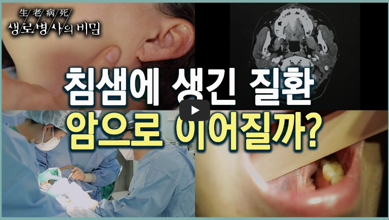 침샘에 생긴 질환은 암의 원인이 될까? (KBS 20230111 방송)