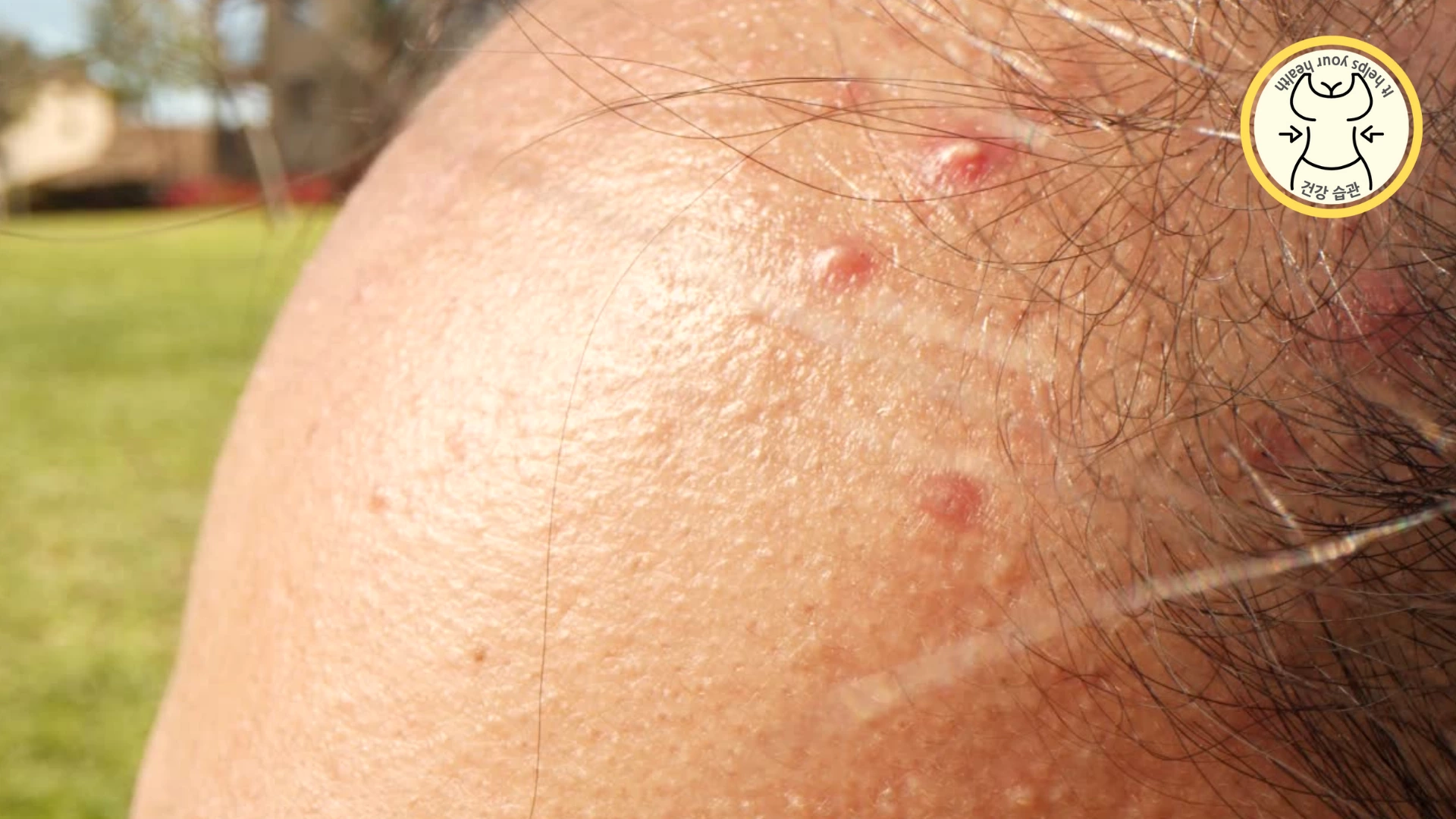 여드름 피부 여드름 피부