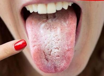 혀 건조증 증상