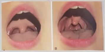 코골이예방준비운동