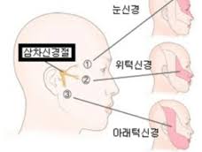 EBS 명의 삼차신경통 원인 증상 치료
