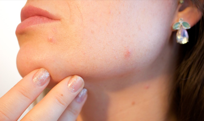 기미없애는방법