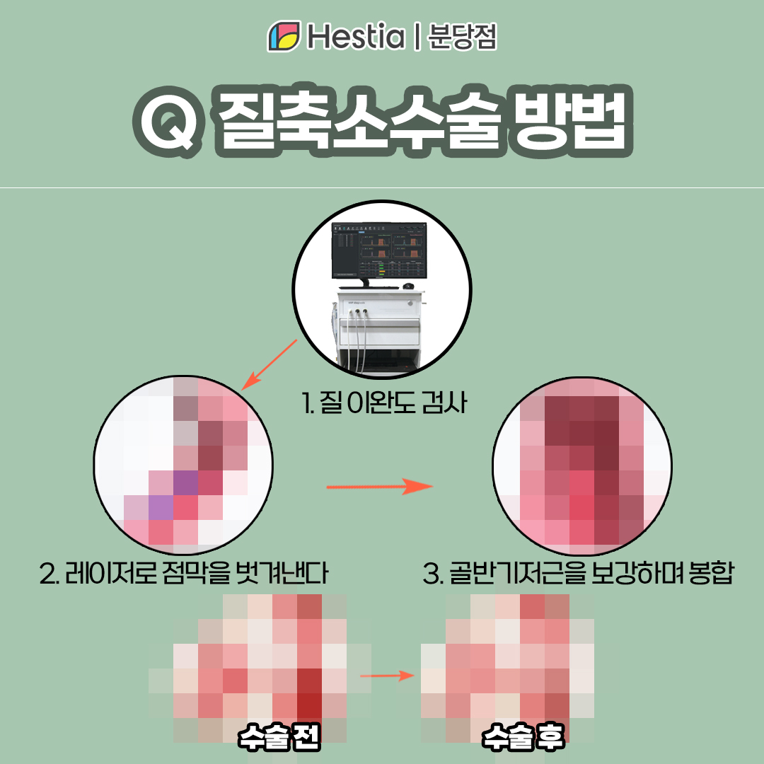질축소수술비용 레이저 질타이트닝 성감 향상 효과적인 질축소방법은?