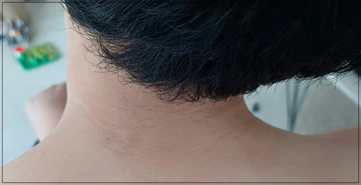 듀피젠트-주사치료후-목덜미-아직-자국-남음