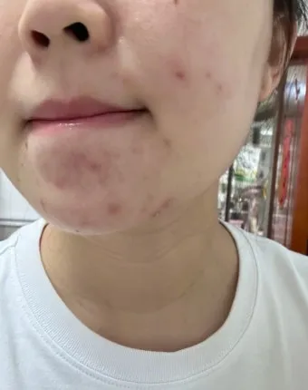 생리 전 뾰루지 폭발 원인과 해결법 7가지 생리 전후 뾰루지 발생 이유 완벽 분석_14