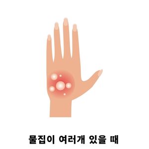 화상 물집 치료방법