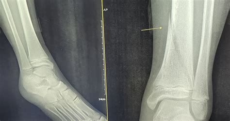 뼈골절 수술비용