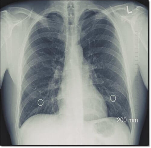 기관지 확장증 증상