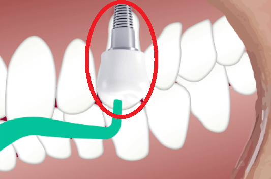 사람치아 사진과 임플란트 치아 사진 : 상악동 골이식술