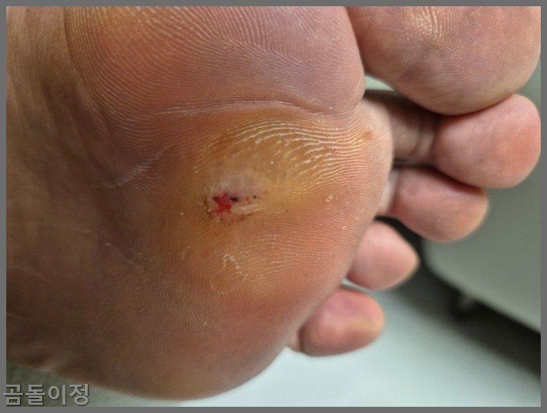 발바닥 티눈 치료법부터 재발 방지까지, 실제 후기로 정리한 팁