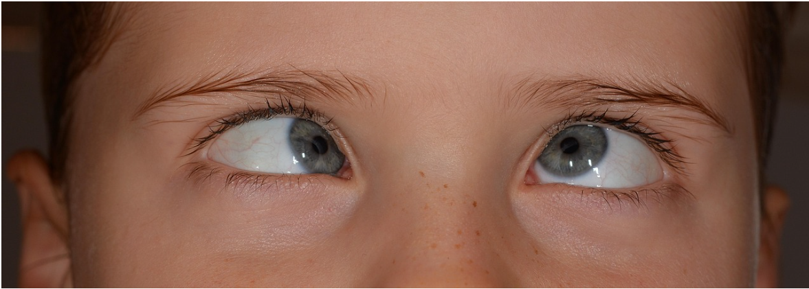 사시(斜視, Strabismus) — 눈의 정렬 이상이 만드는 시각의 불균형과 해결 방법
