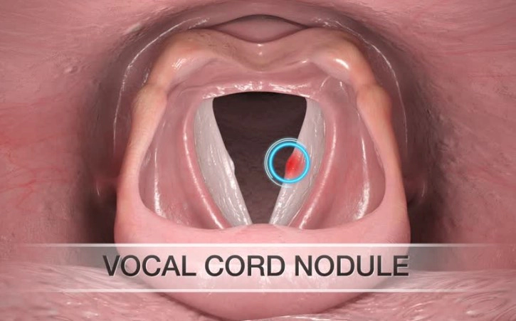 성대결절 증상 원인 자가진단 및 성대결절에 좋은 음식 5가지
