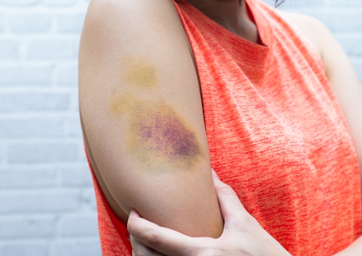 소론도정 부작용