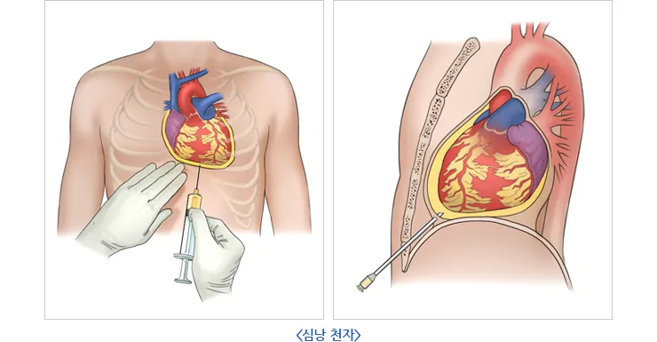 심장에 물이 차는 이유와 관련 질병_1