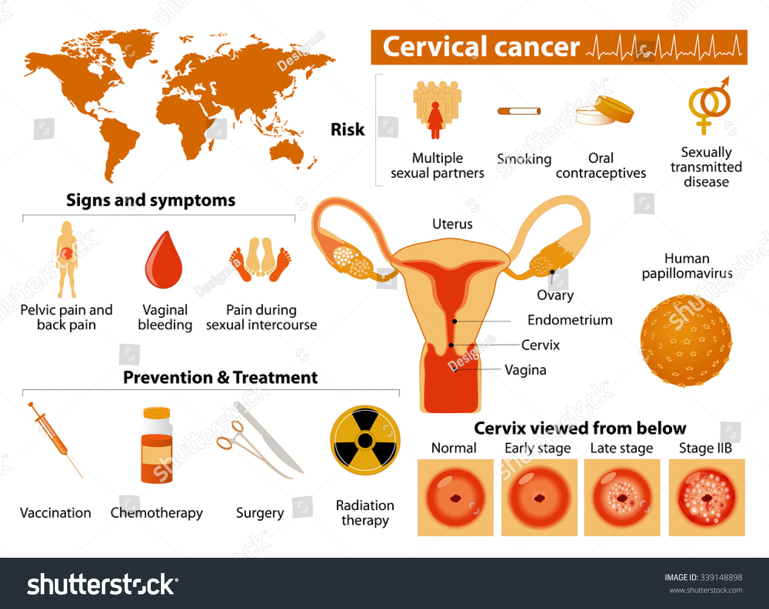 자궁경부암 원인