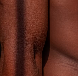 아토피 피부염 진단 기준 치료법 합병증