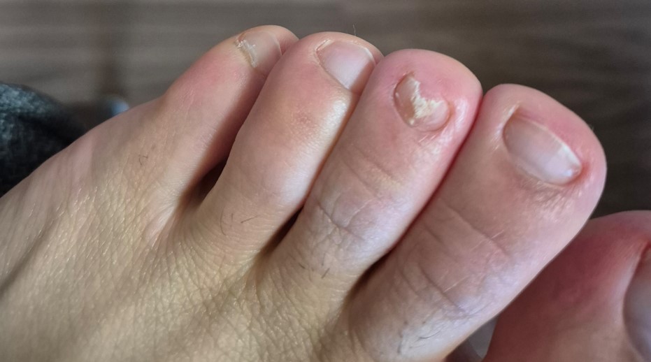 무좀에 걸린 발톱 사진