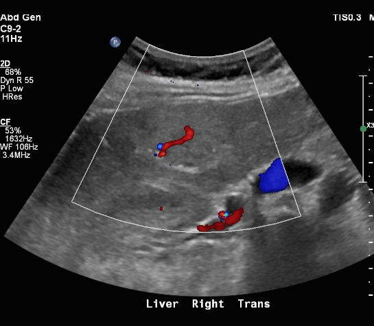 FNH (Focal Nodular hyperplasia)