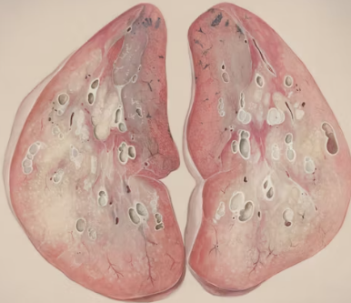 만성폐쇄성 폐질환 증상 치료 원인과 예방법