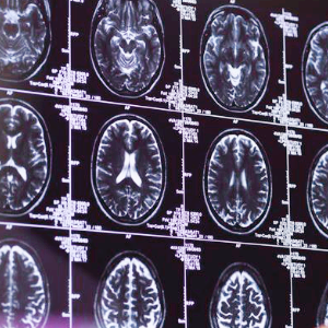 레켐비 관련주 대장주 테마주 수혜주 TOP10